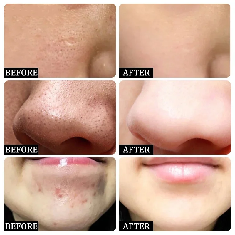 살리실산 모공 클리어링 크림 모공 축소 블랙헤드 제거  - Collagen Peptide Powder 리뷰 및 가격