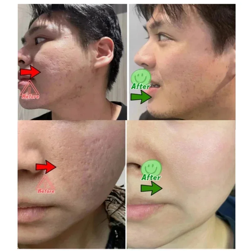 살리실산 모공 클리어링 크림 모공 축소 블랙헤드 제거  - Collagen Peptide Powder 리뷰 및 가격